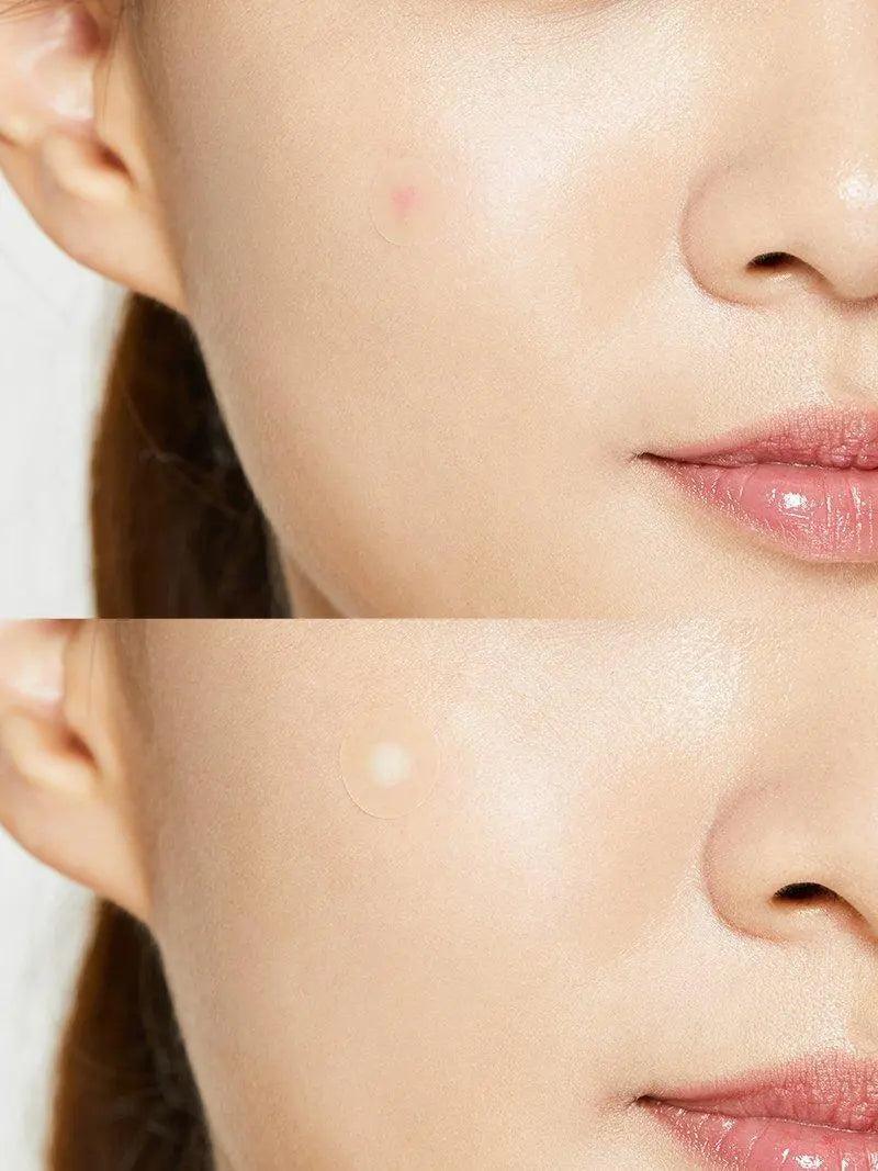 COSRX - Acne Pimple Master Patch - koiyu